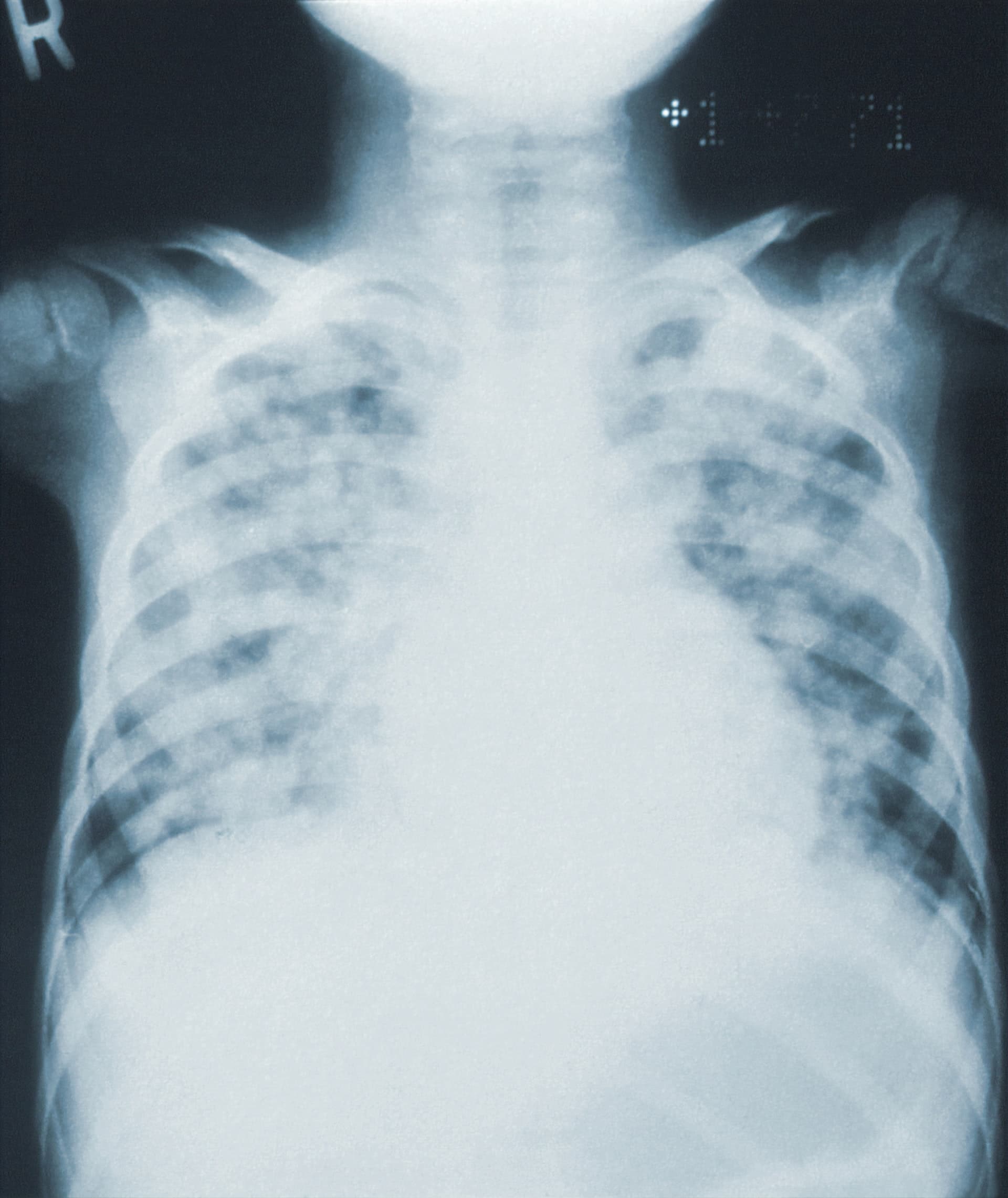 chest xray