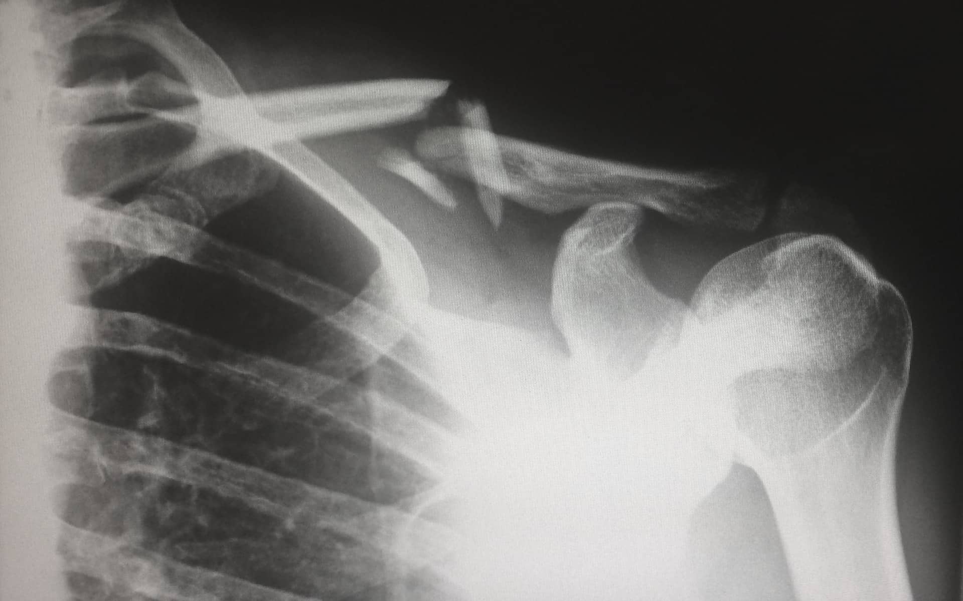 human x-ray of collar bone