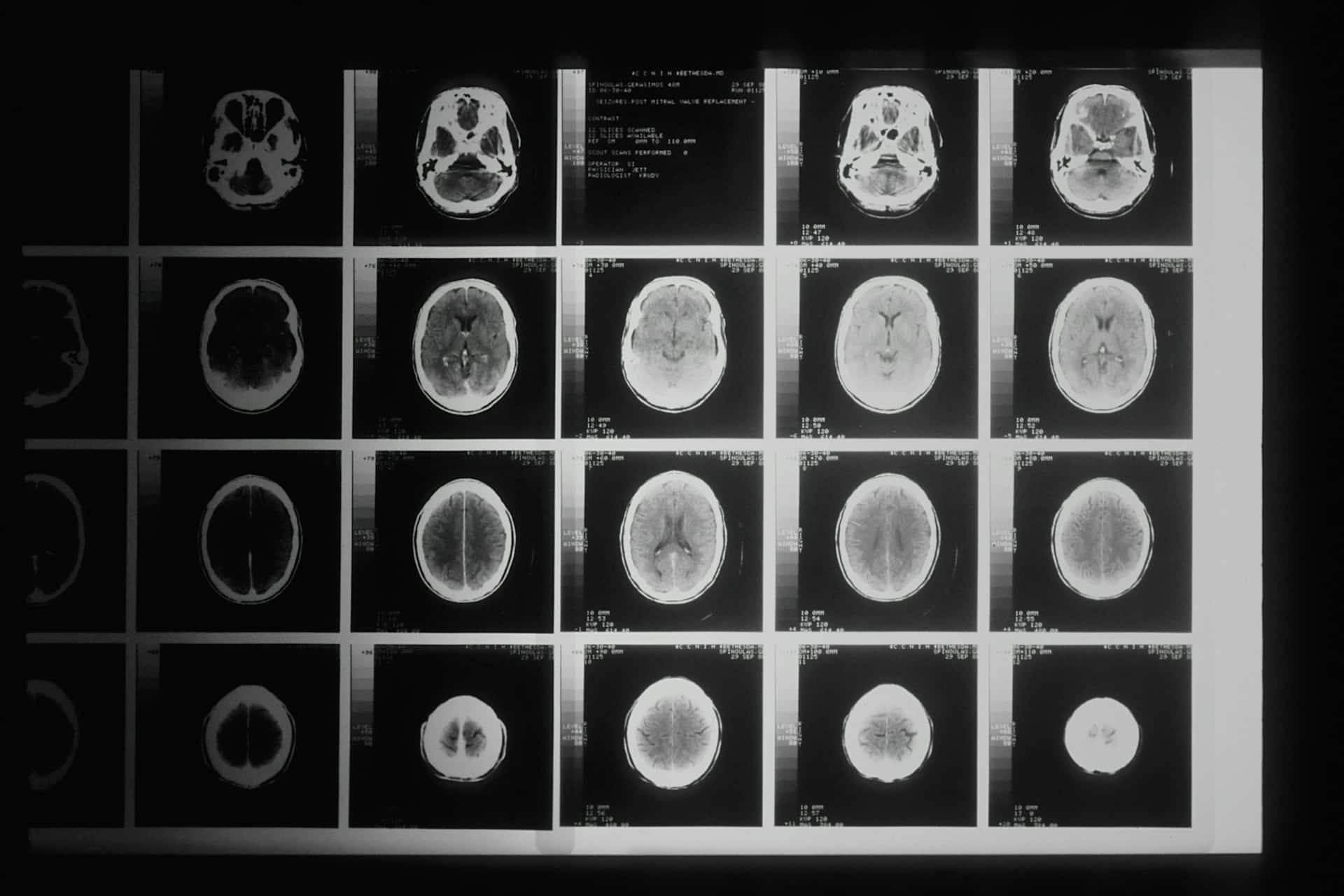 brain ct scan