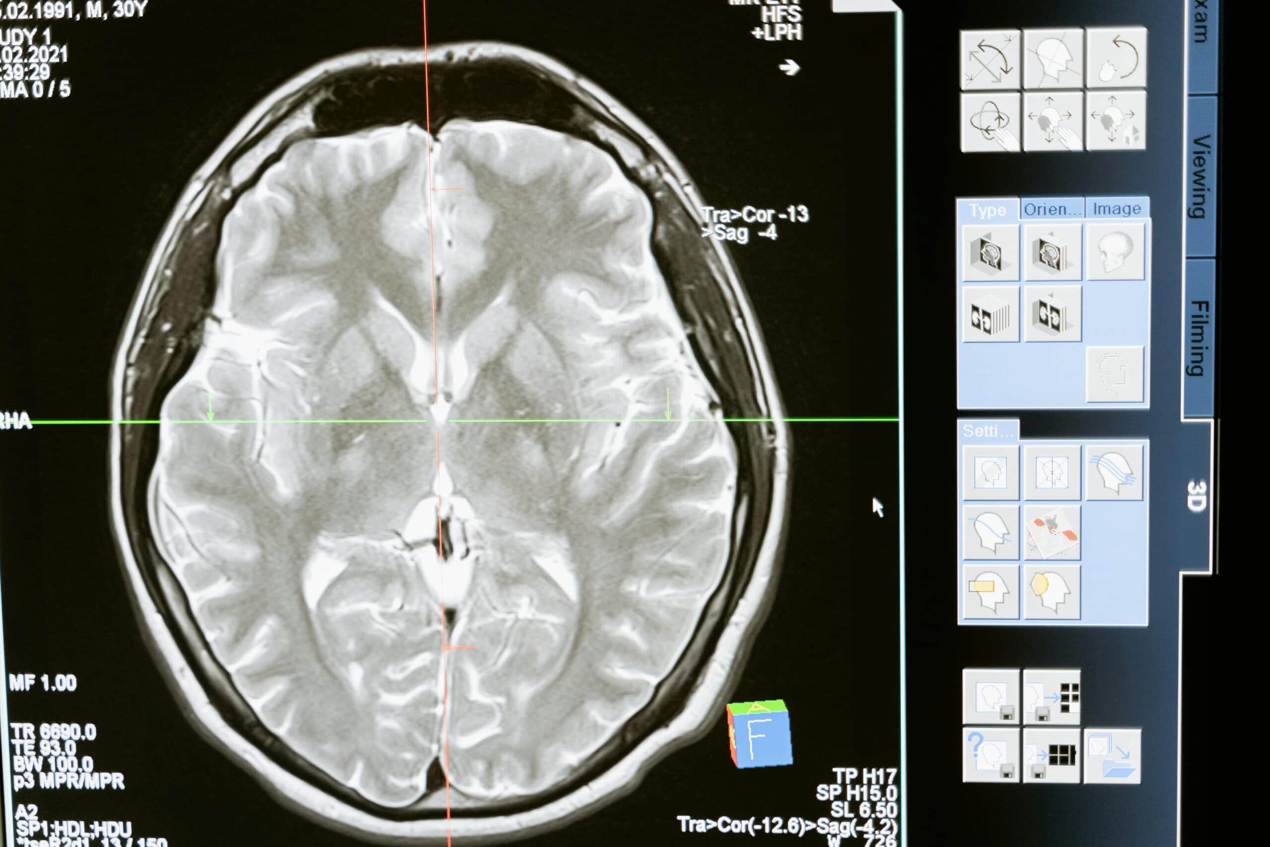 human brain x-ray representing post-concussion syndrome